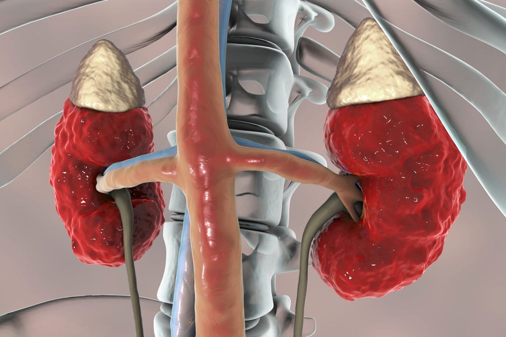 Illustrated image of chronic kidney disease